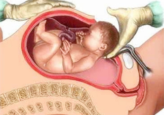 剖腹產(chǎn)比順產(chǎn)安全嗎？剖腹產(chǎn)產(chǎn)后注意事項？