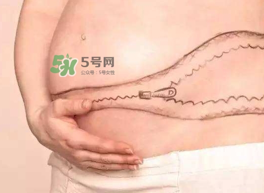 剖腹產(chǎn)疤痕怎么去除？剖腹產(chǎn)疤痕能去掉嗎？