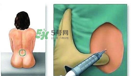 無(wú)痛分娩為什么不提倡？無(wú)痛分娩有后遺癥嗎？