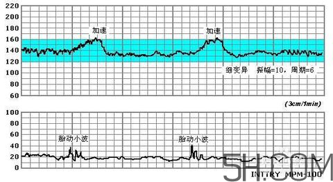 為什么要做胎心監(jiān)護？孕婦做胎心監(jiān)護有什么用？
