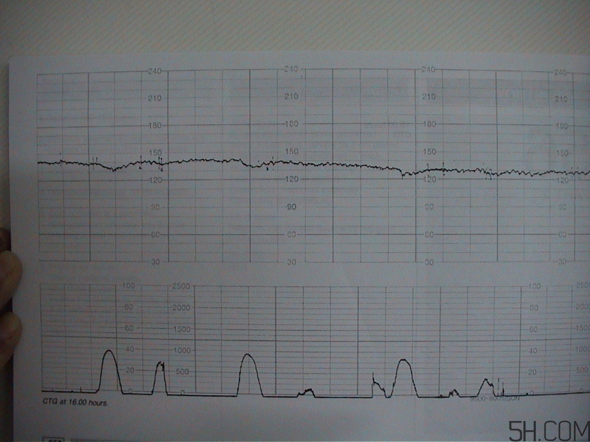 為什么要做胎心監(jiān)護？孕婦做胎心監(jiān)護有什么用？