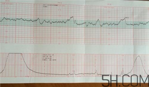 為什么要做胎心監(jiān)護？孕婦做胎心監(jiān)護有什么用？