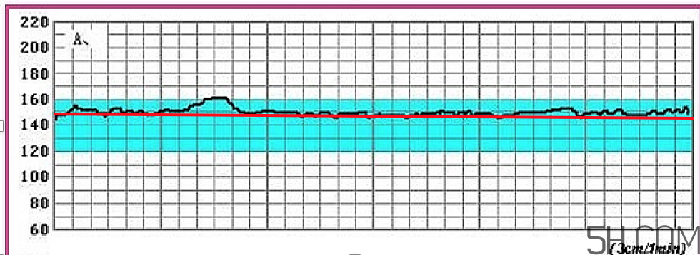 為什么要做胎心監(jiān)護？孕婦做胎心監(jiān)護有什么用？
