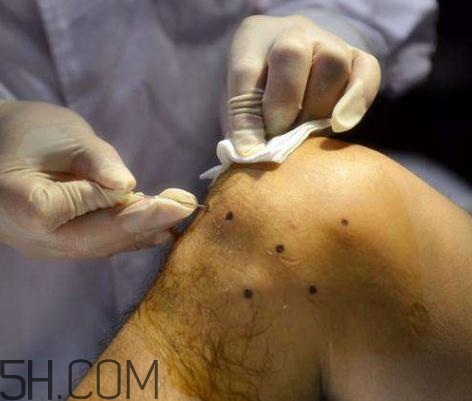 關(guān)節(jié)炎積液什么癥狀？關(guān)節(jié)炎積水怎么治療？