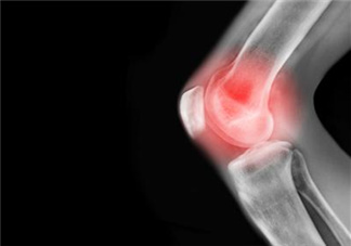 關節(jié)炎需要補鈣嗎？關節(jié)炎補鈣有用嗎？