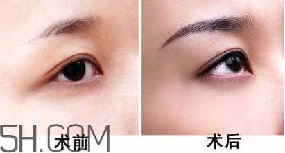 切眉手術(shù)后老得快嗎？切眉能保持多久？