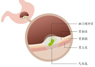 幽門螺桿菌的癥狀有哪些表現(xiàn)？幽門螺旋菌怎么治療