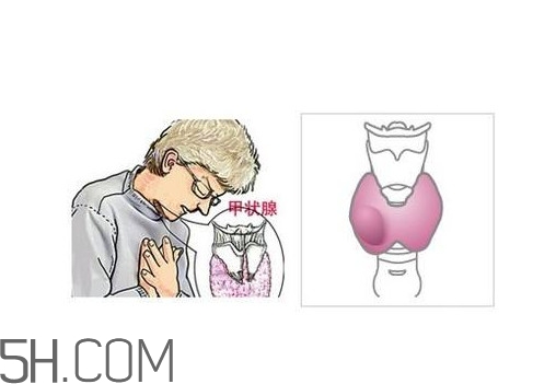為什么會得甲狀腺結(jié)節(jié)？甲狀腺節(jié)結(jié)是什么？