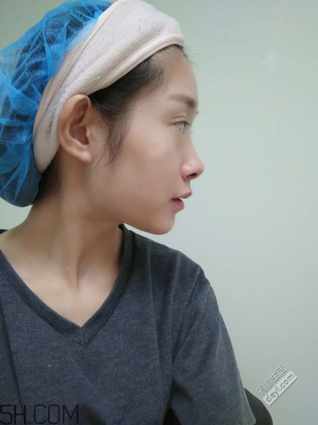 鼻頭縮小術(shù)過(guò)程圖 鼻頭縮小手術(shù)千萬(wàn)別做后悔死 鼻頭縮小術(shù)過(guò)程圖 鼻頭縮小手術(shù)千萬(wàn)別做后悔死