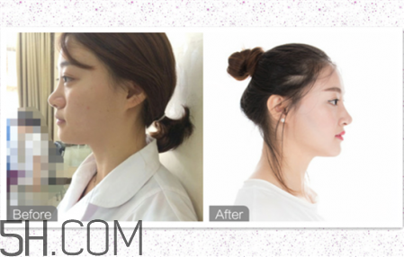 鼻頭縮小術(shù)過(guò)程圖 鼻頭縮小手術(shù)千萬(wàn)別做后悔死 鼻頭縮小術(shù)過(guò)程圖 鼻頭縮小手術(shù)千萬(wàn)別做后悔死