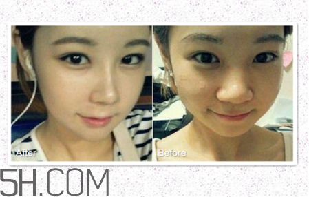 鼻頭縮小術(shù)過(guò)程圖 鼻頭縮小手術(shù)千萬(wàn)別做后悔死 鼻頭縮小術(shù)過(guò)程圖 鼻頭縮小手術(shù)千萬(wàn)別做后悔死