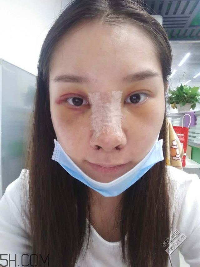 鼻頭縮小術(shù)過(guò)程圖 鼻頭縮小手術(shù)千萬(wàn)別做后悔死 鼻頭縮小術(shù)過(guò)程圖 鼻頭縮小手術(shù)千萬(wàn)別做后悔死