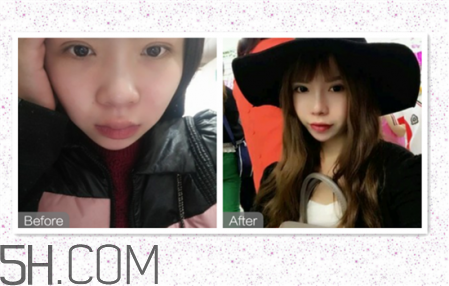 鼻頭縮小術(shù)過(guò)程圖 鼻頭縮小手術(shù)千萬(wàn)別做后悔死 鼻頭縮小術(shù)過(guò)程圖 鼻頭縮小手術(shù)千萬(wàn)別做后悔死