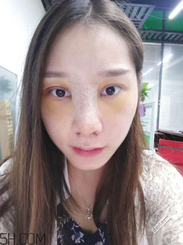 鼻頭縮小術(shù)過(guò)程圖 鼻頭縮小手術(shù)千萬(wàn)別做后悔死 鼻頭縮小術(shù)過(guò)程圖 鼻頭縮小手術(shù)千萬(wàn)別做后悔死