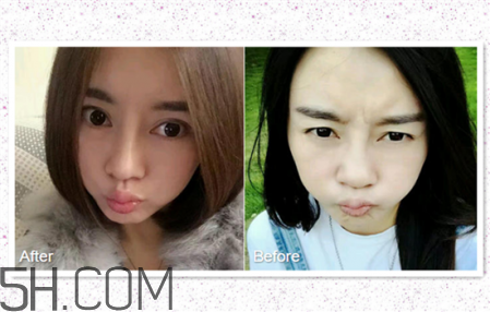 鼻頭縮小術(shù)過(guò)程圖 鼻頭縮小手術(shù)千萬(wàn)別做后悔死 鼻頭縮小術(shù)過(guò)程圖 鼻頭縮小手術(shù)千萬(wàn)別做后悔死