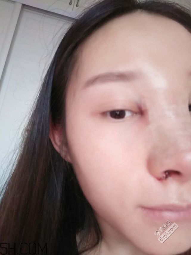 鼻頭縮小術(shù)過(guò)程圖 鼻頭縮小手術(shù)千萬(wàn)別做后悔死 鼻頭縮小術(shù)過(guò)程圖 鼻頭縮小手術(shù)千萬(wàn)別做后悔死