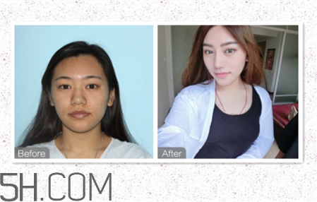 鼻頭縮小術(shù)過(guò)程圖 鼻頭縮小手術(shù)千萬(wàn)別做后悔死 鼻頭縮小術(shù)過(guò)程圖 鼻頭縮小手術(shù)千萬(wàn)別做后悔死