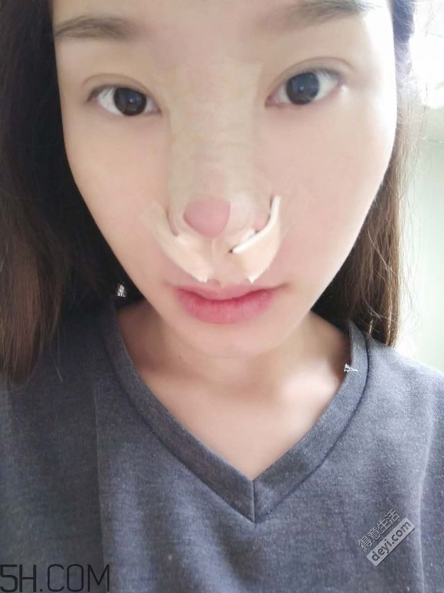 鼻頭縮小術(shù)過(guò)程圖 鼻頭縮小手術(shù)千萬(wàn)別做后悔死 鼻頭縮小術(shù)過(guò)程圖 鼻頭縮小手術(shù)千萬(wàn)別做后悔死