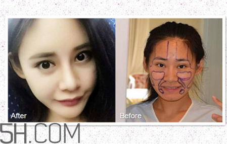 鼻頭縮小術(shù)過(guò)程圖 鼻頭縮小手術(shù)千萬(wàn)別做后悔死 鼻頭縮小術(shù)過(guò)程圖 鼻頭縮小手術(shù)千萬(wàn)別做后悔死