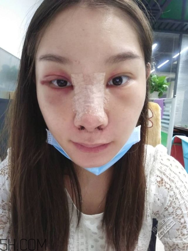 鼻頭縮小術(shù)過(guò)程圖 鼻頭縮小手術(shù)千萬(wàn)別做后悔死 鼻頭縮小術(shù)過(guò)程圖 鼻頭縮小手術(shù)千萬(wàn)別做后悔死