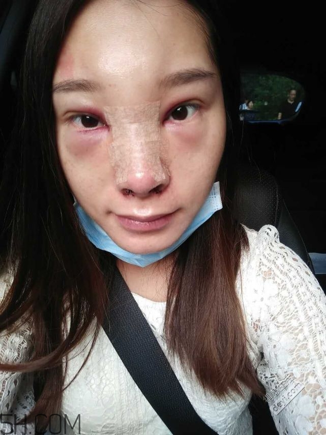 鼻頭縮小術(shù)過(guò)程圖 鼻頭縮小手術(shù)千萬(wàn)別做后悔死 鼻頭縮小術(shù)過(guò)程圖 鼻頭縮小手術(shù)千萬(wàn)別做后悔死