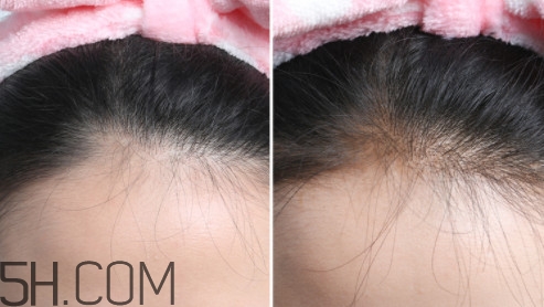 發(fā)際線不好看怎么修飾 完美解決6種發(fā)際線問(wèn)題 發(fā)際線不好看怎么修飾 完美解決6種發(fā)際線問(wèn)題