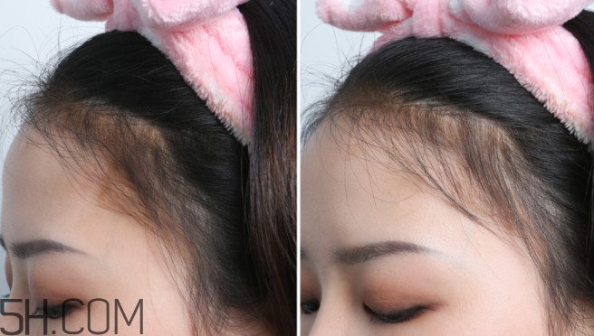 發(fā)際線不好看怎么修飾 完美解決6種發(fā)際線問(wèn)題 發(fā)際線不好看怎么修飾 完美解決6種發(fā)際線問(wèn)題