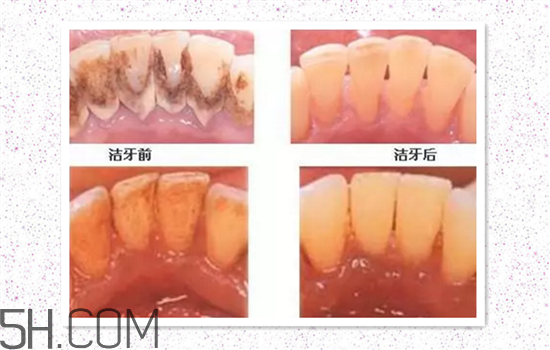 超聲波洗牙可以美白牙齒嗎？超聲波洗牙多少錢一次？
