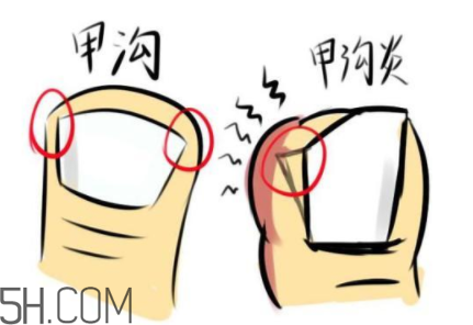 為什么容易得甲溝炎？怎么根治甲溝炎？