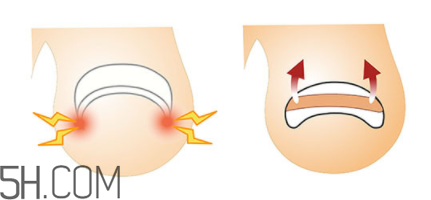 為什么容易得甲溝炎？怎么根治甲溝炎？