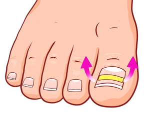 為什么容易得甲溝炎？怎么根治甲溝炎？