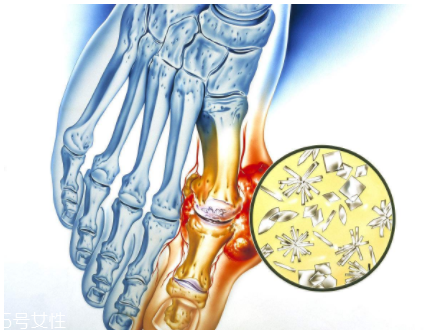 痛風(fēng)可以治愈嗎？無法治愈但能控制