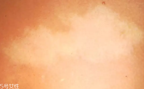 痣什么情況下會轉變?yōu)榱?？點痣不可取