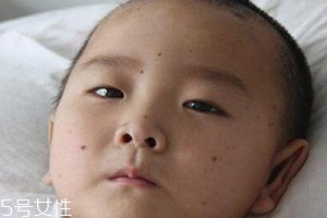 痣什么情況下會轉變?yōu)榱?？點痣不可取