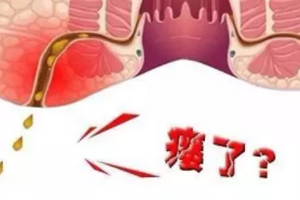 肛瘺非手術治療才可以嗎？手術是治療的關鍵途徑