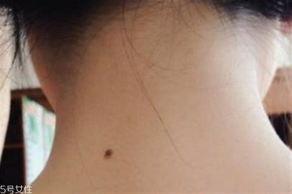 脖子后面有痣好嗎？激光冷凍祛痣易導(dǎo)致癌變