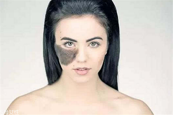 胎記長在哪里有福氣？胎記的本質(zhì)是色素沉著