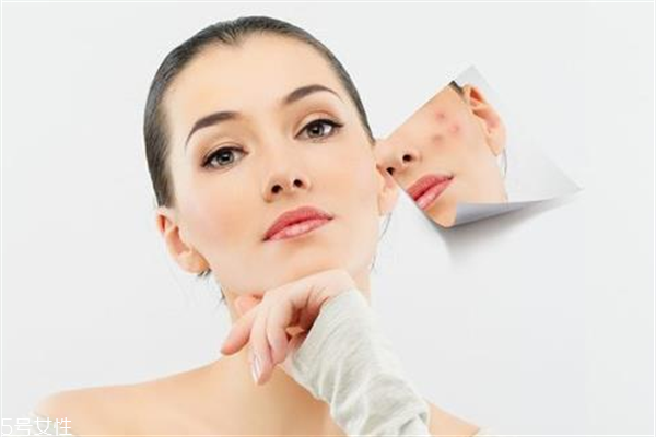 去胎記要多少錢？胎記去除后要做好護理