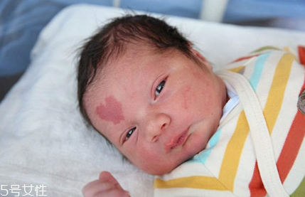 胎記長(zhǎng)在哪里有福氣？胎記的本質(zhì)是色素沉著