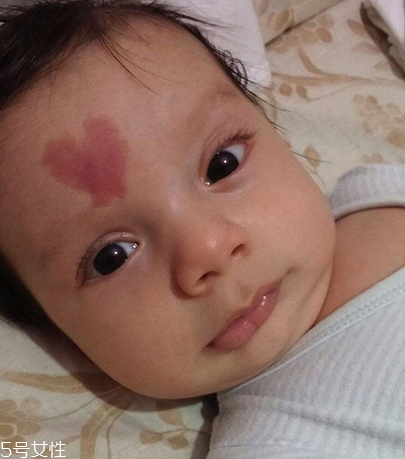 胎記長(zhǎng)在哪里有福氣？胎記的本質(zhì)是色素沉著