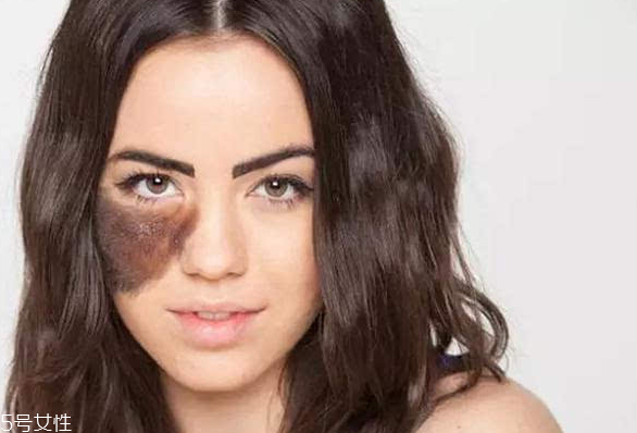 胎記長(zhǎng)在哪里有福氣？胎記的本質(zhì)是色素沉著