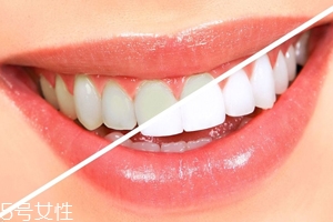 牙齒發(fā)黃是天生的嗎？只是你刷牙偷懶了