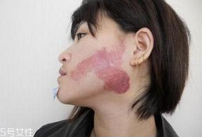 胎記怎么去除？胎記有遺傳的可能