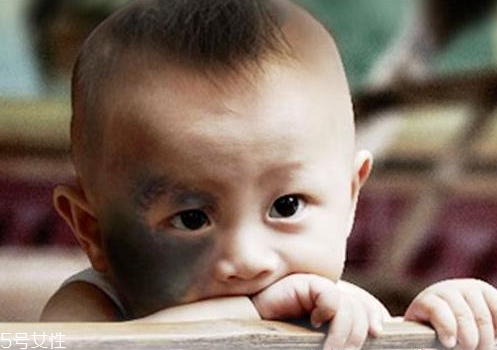 胎記怎么去除？胎記有遺傳的可能