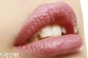 冬天爛嘴角什么原因？有可能營(yíng)養(yǎng)不良