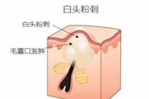 閉口是怎么引起的？4種情況要注意