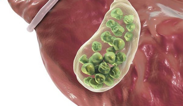 不吃早餐為什么會得膽結(jié)石 不吃早餐為什么會得膽結(jié)石