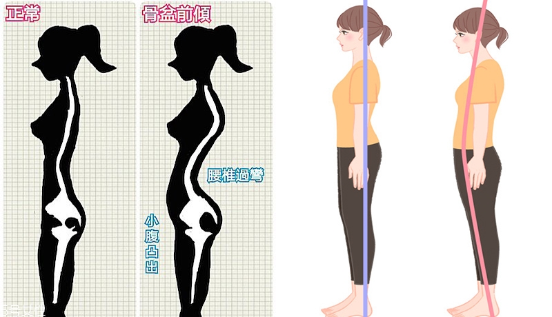 骨盆前傾如何矯正 骨盆前傾矯正動作圖解 骨盆前傾如何矯正 骨盆前傾矯正動作圖解
