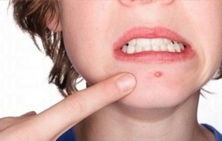 臉不同部位長痘痘的原因 臉上各部位長痘原因 臉不同部位長痘痘的原因 臉上各部位長痘原因