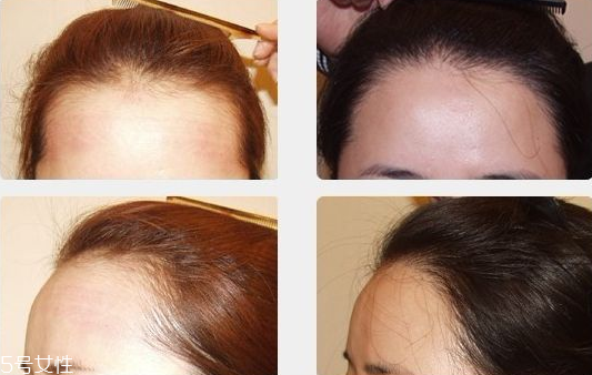 發(fā)際線低可以脫毛嗎 可以有效改善 發(fā)際線低可以脫毛嗎 可以有效改善